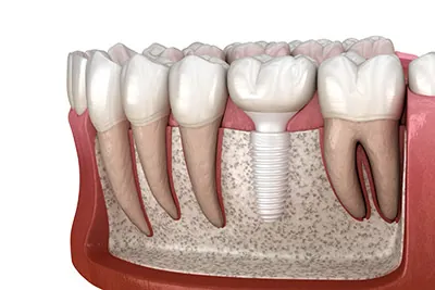 3D model of how a ceramic dental implant works