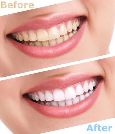 before and after photos of a patient's smile after getting her teeth whitened at Lynn Dental Care